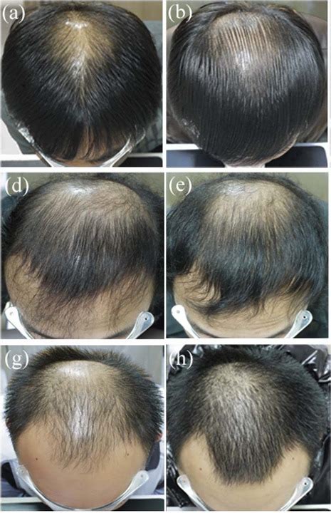 finasteride results after 6 months|Finasteride (Propecia). What To Expect: The Timeline .